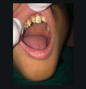 تغییر دندان در نرمی استخوان در کودکان 