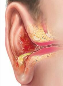 علایم بیماری گوش شناگر