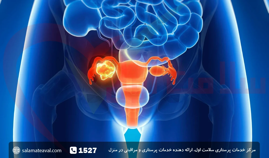 علت ایجاد تومور و سرطان مثانه در زنان و مردان