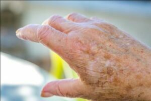 علایم اگزما در سالمندان