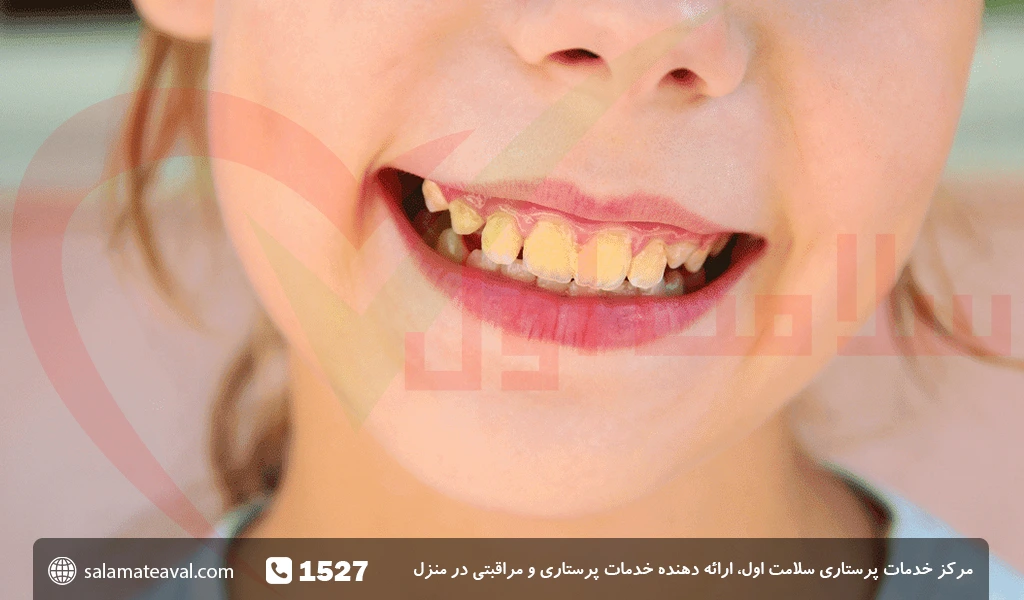 علت زردی دندان کودکان
