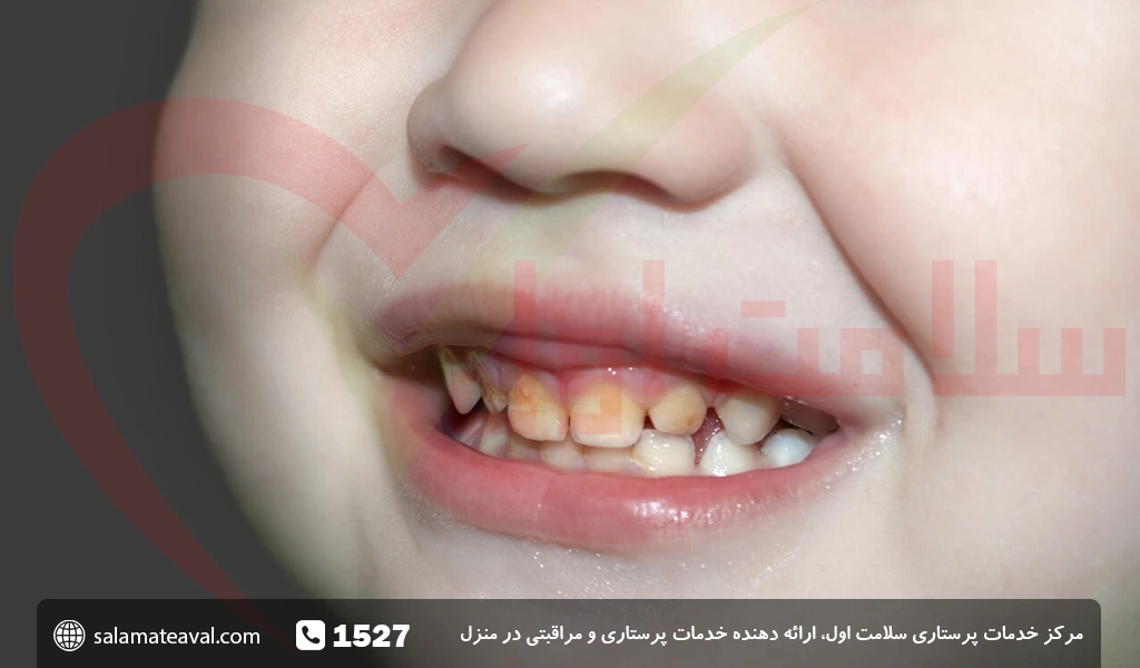 درمان خانگی زرد شدن دندان کودک