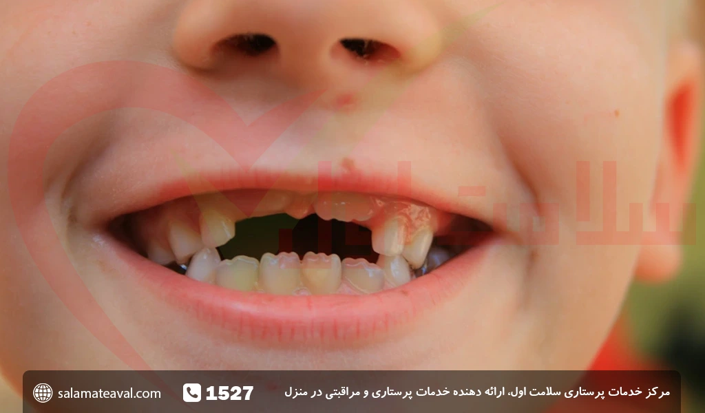 پیشگیری از زرد شدن دندان های کودک