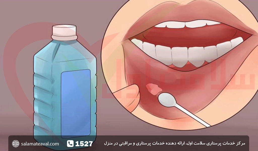 درمان قطعی آفت دهان در منزل
