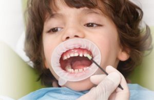 فلوراید درمانی دندان کودکان