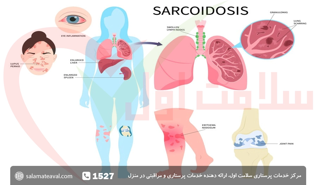 بیماری سارکوئیدوز چیست