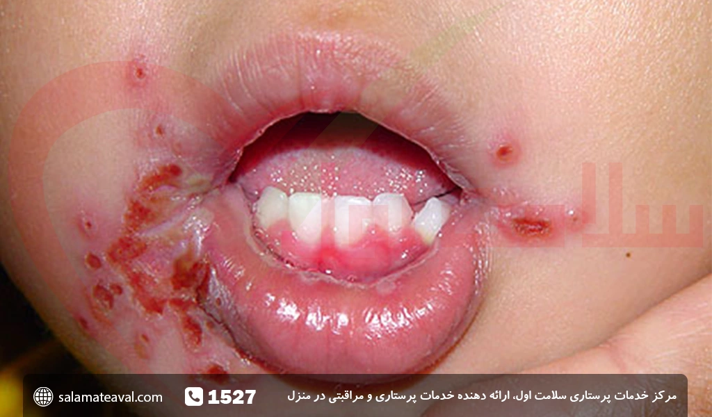 علائم تبخال دهان در کودکان و نوزادان