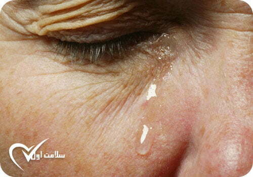مشکل ریزش اشک در سالمندان