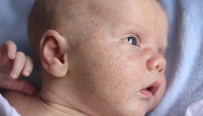 اوریتیکاریا از مشکلات پوستی نوزادان