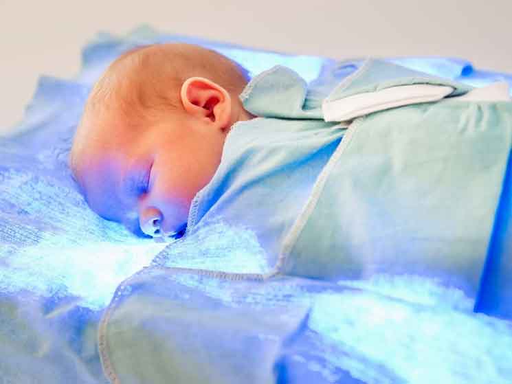 درمان زردی در اولین نوزاد سالم
