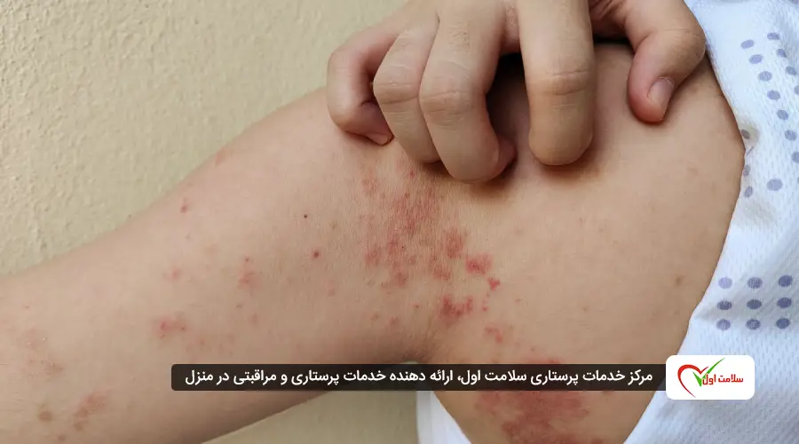 علائم رایج بیماریهای خودایمنی چیست؟