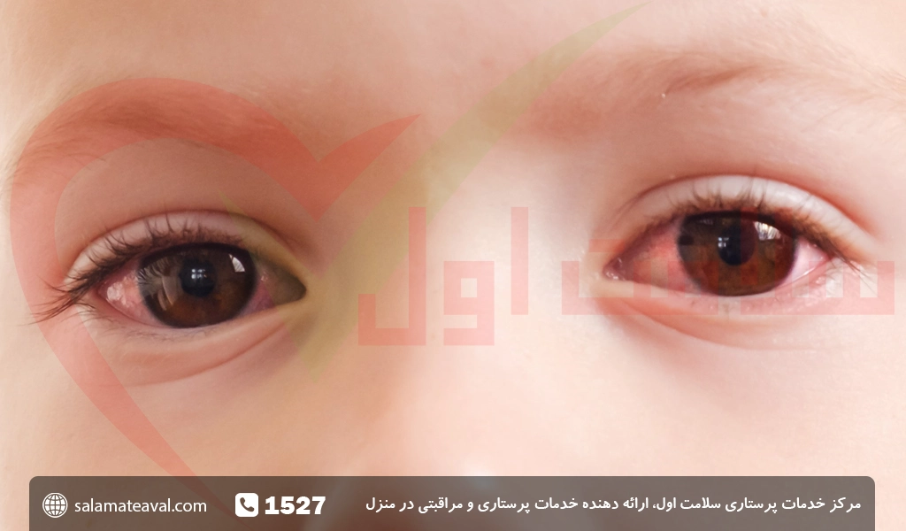 عفونت چشم کودک