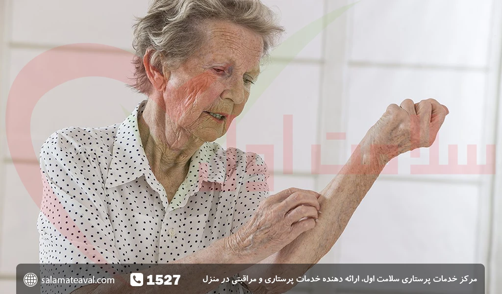 بیماری اگزما در سالمندان