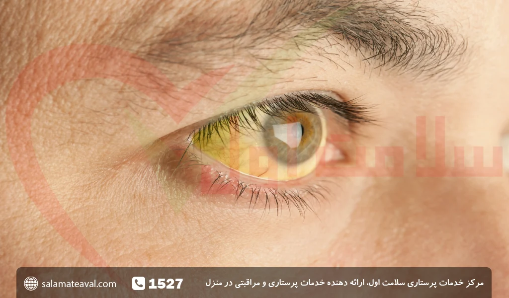 علائم تخریب لکه زرد چشم و ماکولای خشک و مرطوب