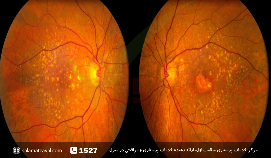 انواع بیماری تخریب لکه شبکیه زرد چشم