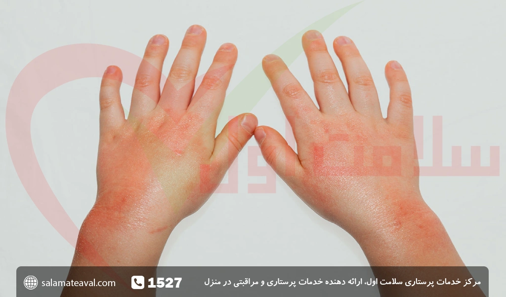 علل ایجاد اگزما پوستی