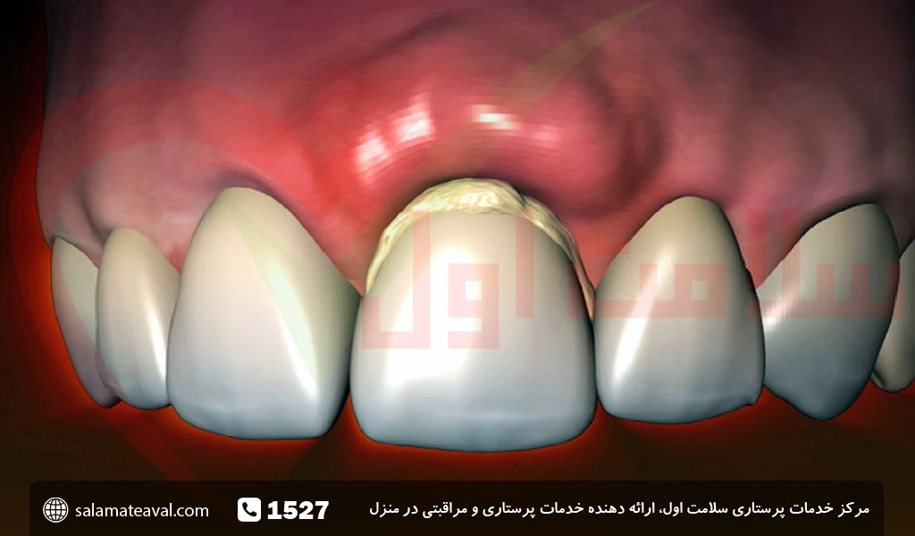 علائم و عکس آبسه دندان و لثه 