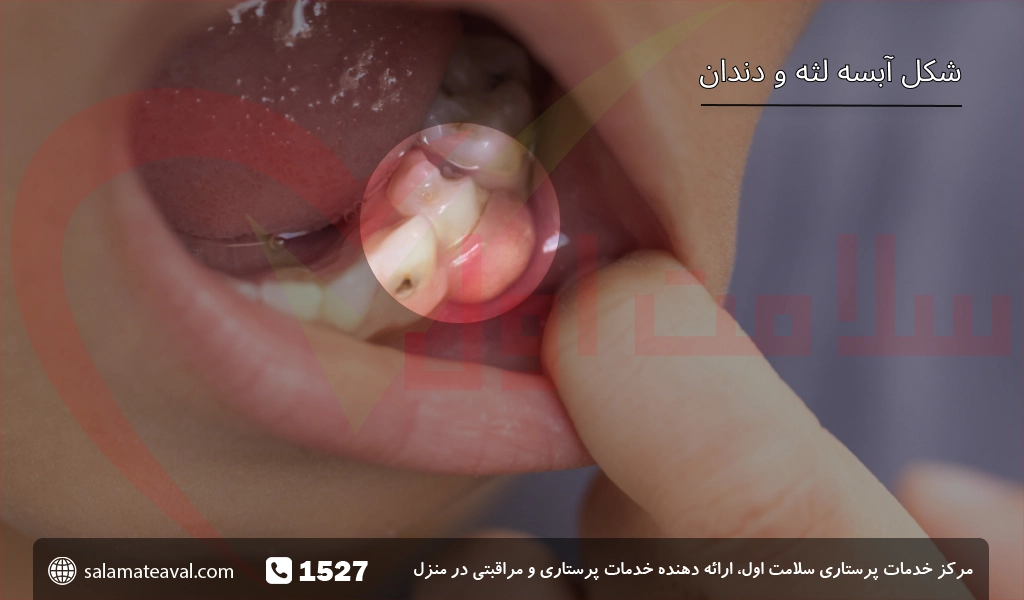 عکس آبسه لثه و دندان کودکان