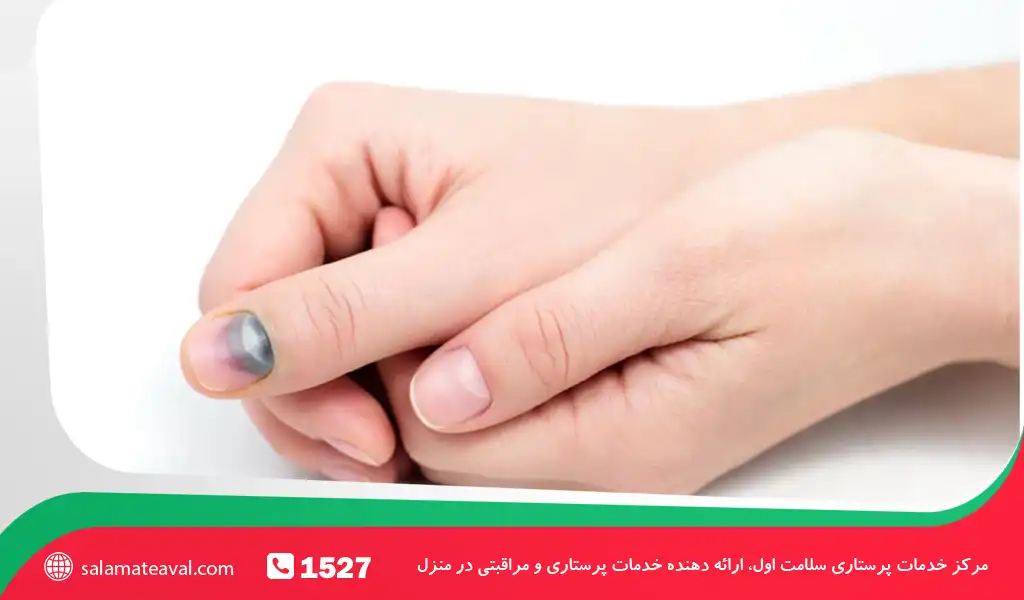 روند بهبودی و رشد مجدد ناخن پس از کبودی