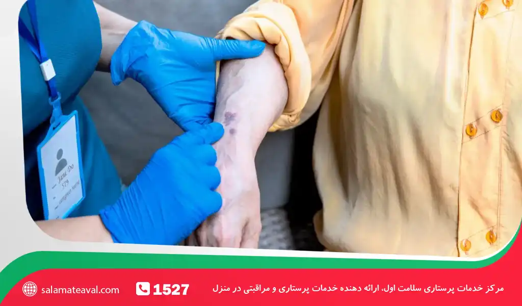 پدیده کبودی ناگهانی در سالمندان و شیوع آن