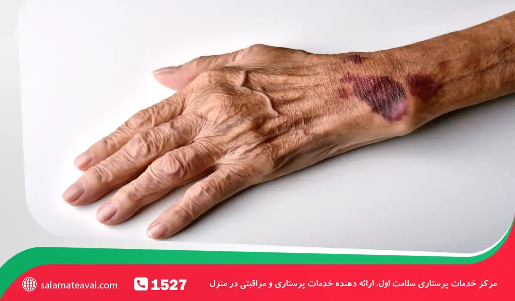 کبودی ناگهانی در سالمندان