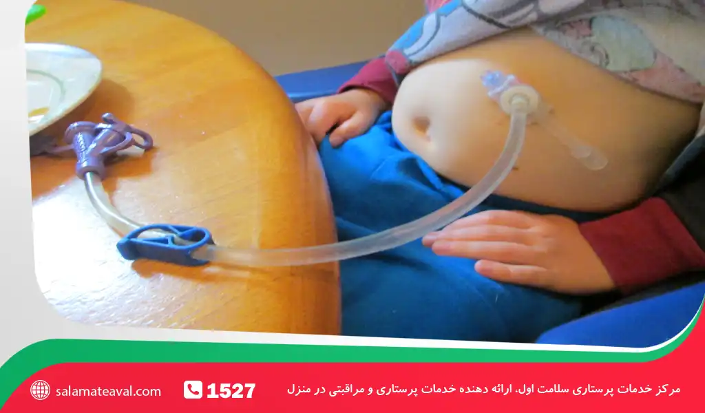 نکات ایمنی و پیشگیری از عوارض در خدمات پرستاری بیماران NG و PEG در منزل