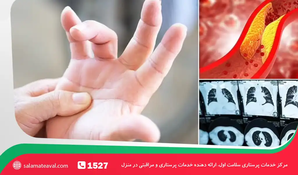 علائم پنهان کلسترول بالا روی انگشتان دست