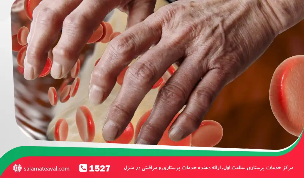 چگونه انقباض دوپوترن با کلسترول بالا مرتبط است؟