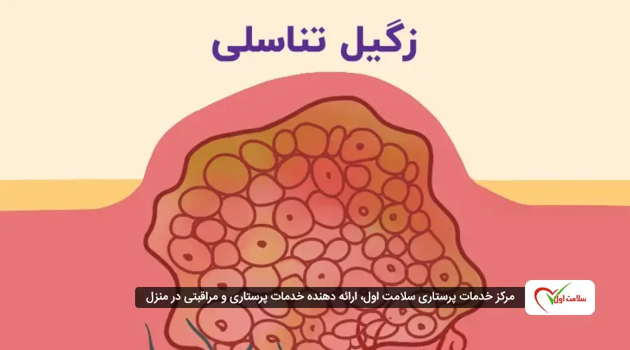 زگیل تناسلی زنان