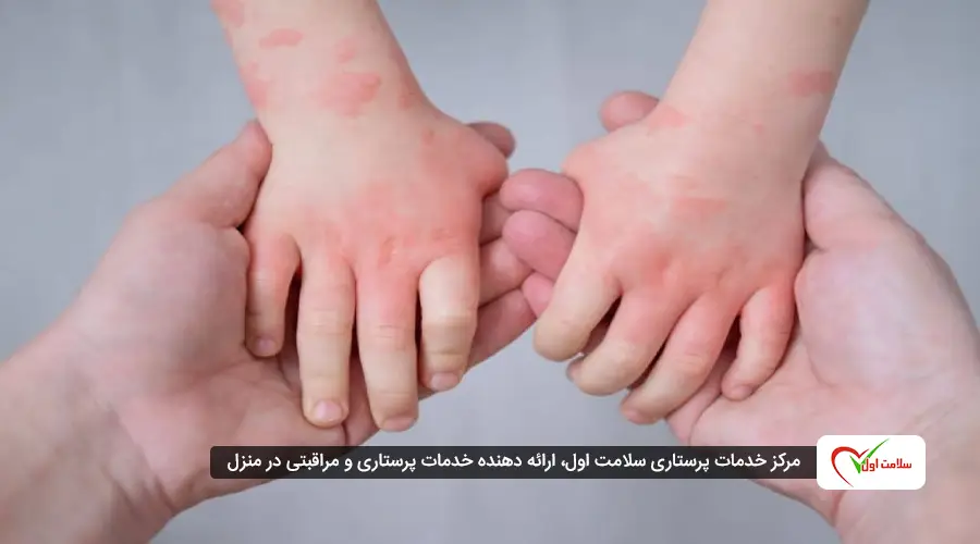 واکنشهای پوستی شایع شامل کهیر (ضایعات قرمز و خارشدار)، اگزما (خشکی و التهاب پوست)، قرمزی و خارش در نواحی مانند صورت، پلکها، لبها یا گردن هستند.