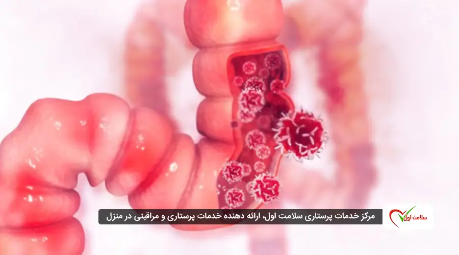 نشانه های سرطان روده بزرگ