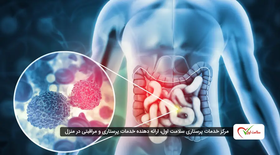 تشخیص علائم سرطان روده