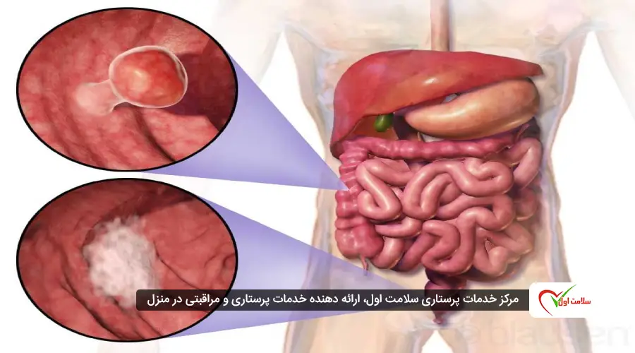 سرطان روده بیماریای است که از سلولهای پوششی روده آغاز میشود و میتواند به بافتهای اطراف یا سایر اعضای بدن گسترش یابد.