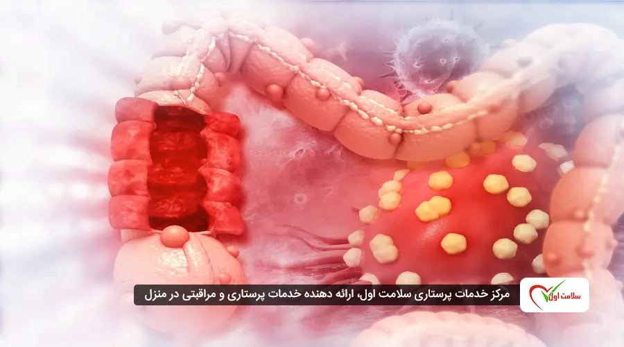 علائم سرطان روده بزرگ در زنان