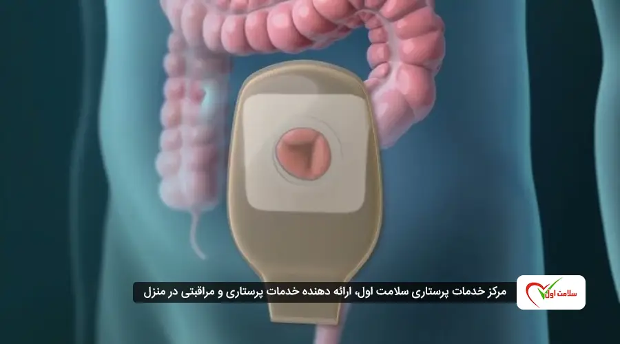 مراقبت از استوما بعد از جراحی سرطان کولون