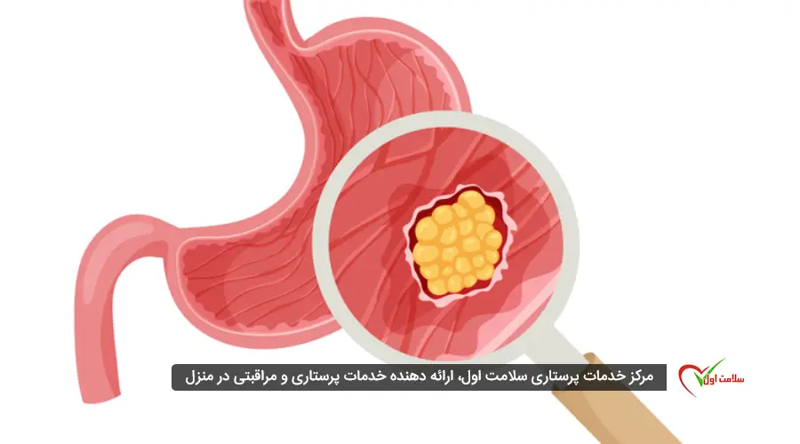 علائم سرطان معده خوش خیم