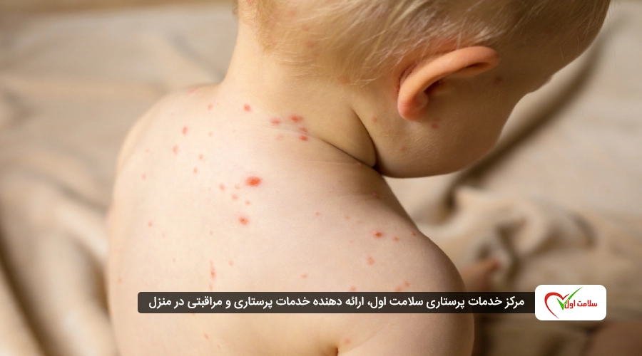 آبله مرغان چگونه منتقل میشود و کدام راهها خطرناک ترند؟