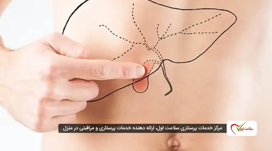 علائم سنگ کیسه صفرا در زنان و مردان