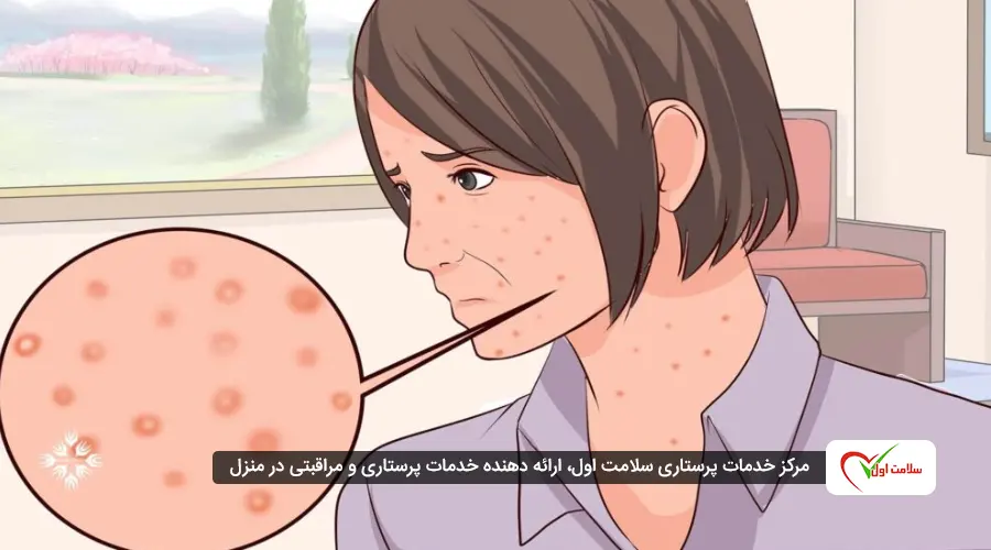 بیماری پوستی زونا