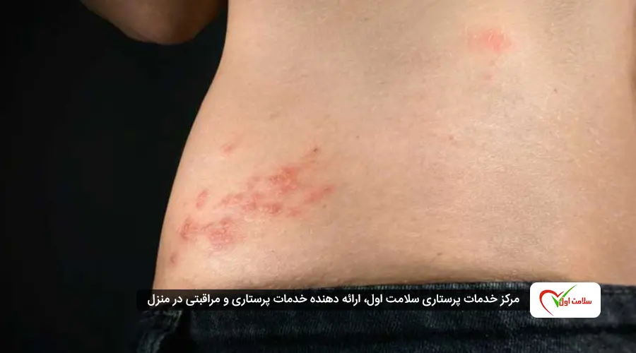 بیماری زونا چیست