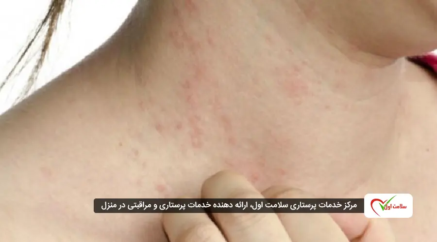 بیماری زونا چیست و راه درمان