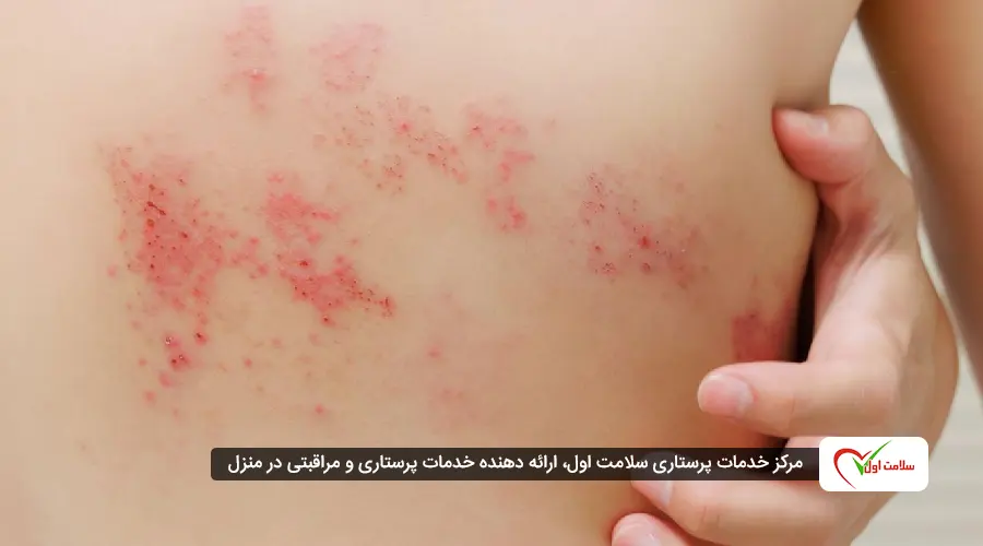 زونا چیست ؟