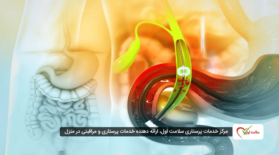 عوارض گوارشی برداشتن کیسه صفرا در بلندمدت