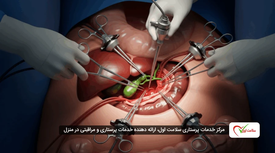 عوارض برداشتن کیسه صفرا در زنان و مردان