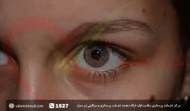 سرطان ملانوم چشم