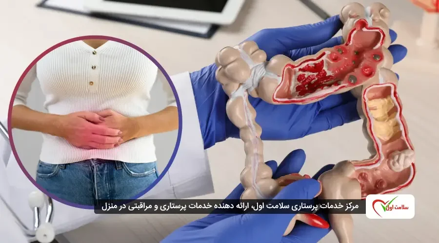 علائم سرطان روده بزرگ