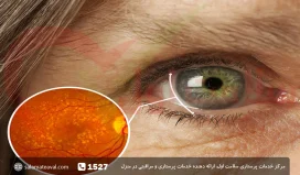 تخریب لکه زرد چشم در سالمندان