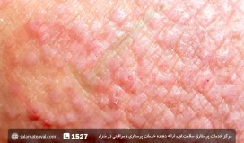 درماتیت تماسی