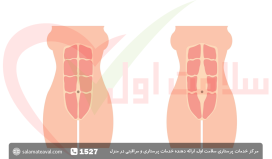 دیاستاز رکتوس شکمی