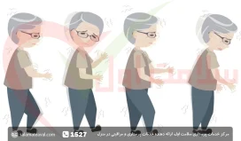 طول عمر بیماران پارکینسون